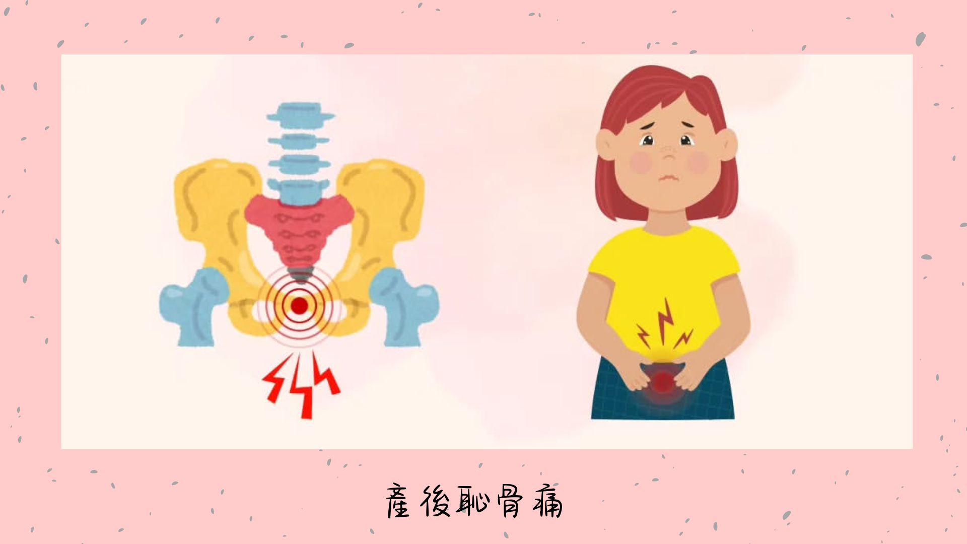 產後恥骨痛
