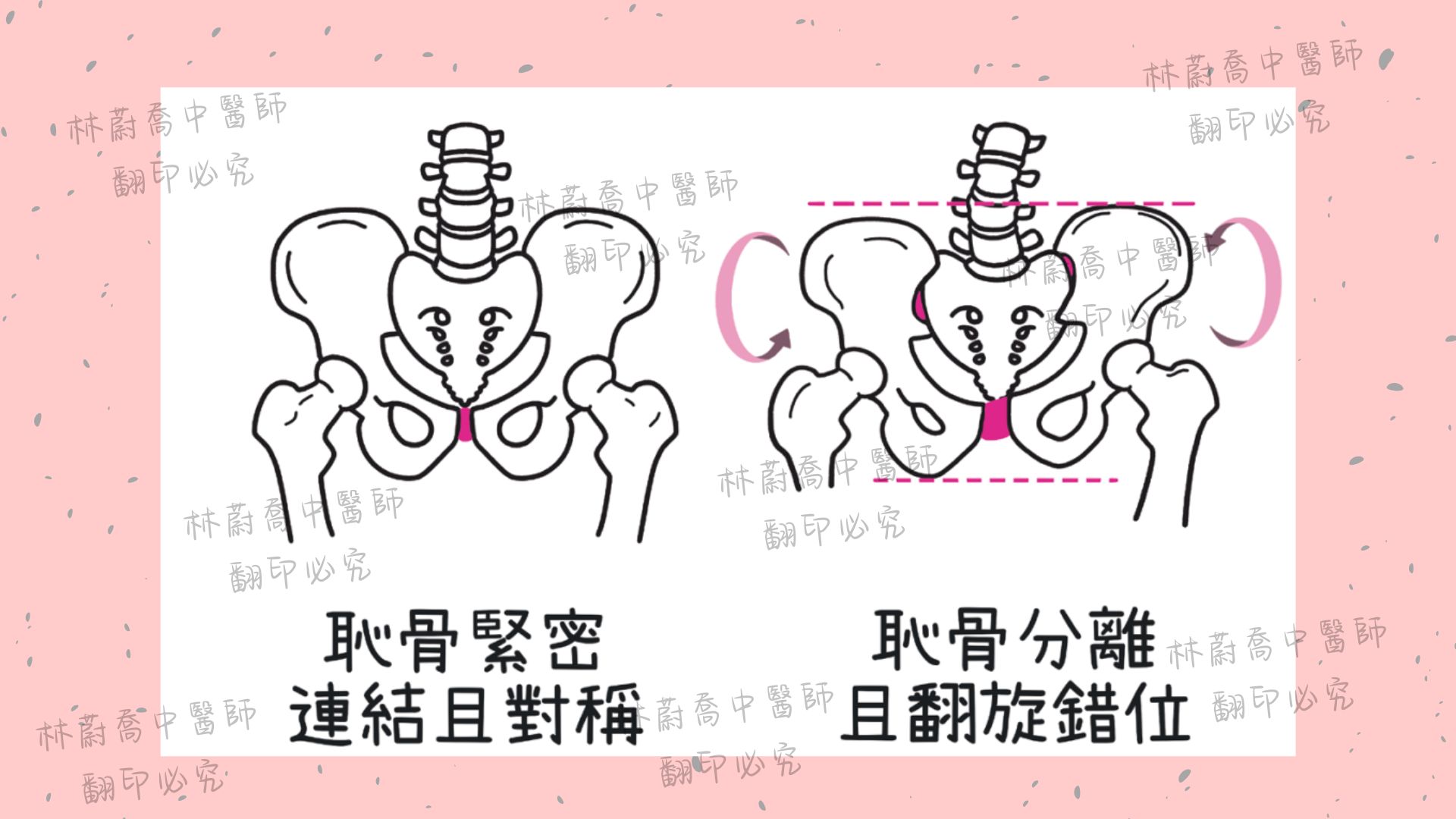 恥骨聯合分離錯位